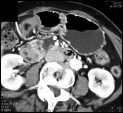 Intraductal Papillary Mucinous Neoplasm (IPMN) - CTisus CT Scan