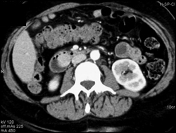 Neurofibroma of Ampulla in Patient With Neurofibromatosis - CTisus CT Scan