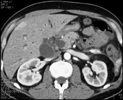 Dilated Common Bile Duct (CBD) Due to Ampullary Cancer - CTisus CT Scan