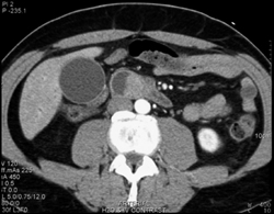 Ampullary Cancer - CTisus CT Scan