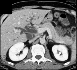 Ampullary Cancer - CTisus CT Scan