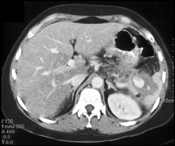 Pseudoaneurysm of Splenic Artery - CTisus CT Scan