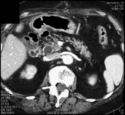 Ampullary Cancer - CTisus CT Scan