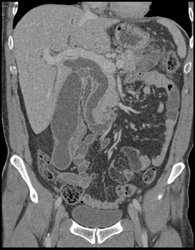 Ampullary Cancer - CTisus CT Scan