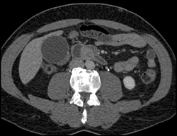 Ampullary Cancer - CTisus CT Scan