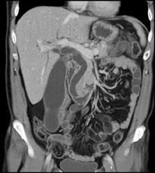 Ampullary Cancer - CTisus CT Scan