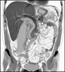 Inverted ???? and Able to See Common Bile Duct (CBD) - CTisus CT Scan