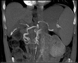 Collateral Off SMA and Gastroduodenal Artery (GDA) - CTisus CT Scan