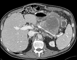 Pancreatic Cancer Encases the Splenic Vein - CTisus CT Scan