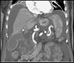 Cystic Tumor of Pancreatic Head and Uncinate - CTisus CT Scan