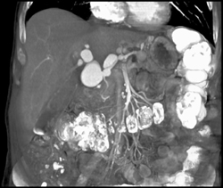 Multiple Metastatic Artery Aneurysms in 74 Year Old Male - CTisus CT Scan