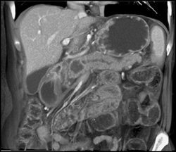 Intraductal Papillary Mucinous Neoplasm (IPMN) - CTisus CT Scan