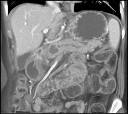 Intraductal Papillary Mucinous Neoplasm (IPMN) - CTisus CT Scan