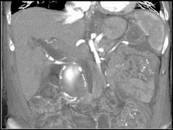 Aortic Aneurysm Adjacent to Common Bile Duct (CBD) - CTisus CT Scan