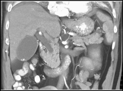 Nonopaque Stone in Distal Common Bile Duct (CBD) - CTisus CT Scan