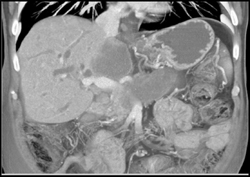 Encased PV/SMV - CTisus CT Scan