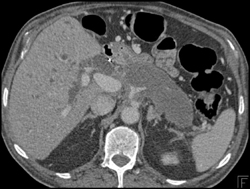 Encased Celiac and SMA - CTisus CT Scan