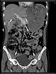 Partially Occluded Superior Mesenteric Vein (SMV) - CTisus CT Scan