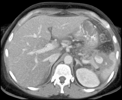 Splenic Artery Pseudoaneurysm - CTisus CT Scan