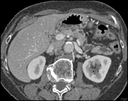 Dilated Pancreatic Duct Due to Proximal Tumor - CTisus CT Scan