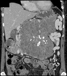 Serous Cystadenoma - CTisus CT Scan