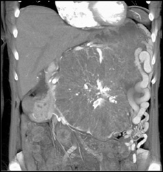 Serous Cystadenoma - CTisus CT Scan