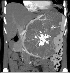 Serous Cystadenoma - CTisus CT Scan