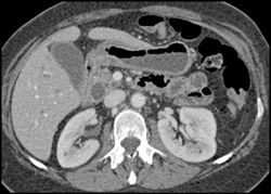 Carcinoid of the Ampulla - CTisus CT Scan