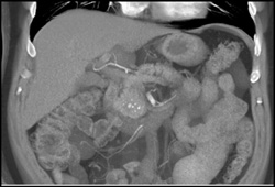 Chronic Pancreatitis Simulates A Mass - CTisus CT Scan