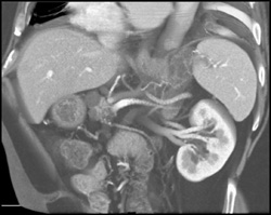 Intraductal Papillary Mucinous Neoplasm (IPMN) - CTisus CT Scan