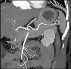 Normal SMA and Celiac Artery - CTisus CT Scan