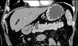 Intraductal Papillary Mucinous Neoplasm (IPMN) - CTisus CT Scan