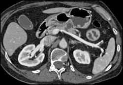 Intraductal Papillary Mucinous Neoplasm (IPMN) - CTisus CT Scan