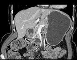 Intraductal Papillary Mucinous Neoplasm (IPMN) in Uncinate - CTisus CT Scan