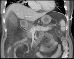 Chronic Pancreatitis - CTisus CT Scan