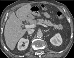 Several Intraductal Papillary Mucinous Neoplasms (IPMNs) - CTisus CT Scan