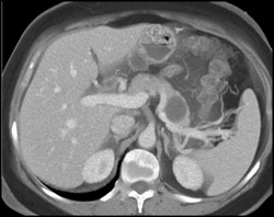 Cystadenoma - CTisus CT Scan