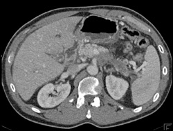 Acute Pancreatitis - CTisus CT Scan