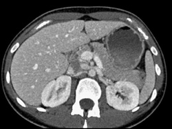 Pancreatic Laceration Due to MVA - CTisus CT Scan