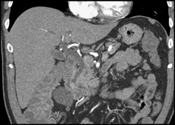 Ampullary Tumor That Enhances - CTisus CT Scan