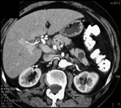 Intraductal Papillary Mucinous Neoplasm (IPMN) and Adrenal Adenoma (lt) - CTisus CT Scan