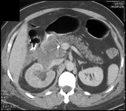 Perforation Post ERCP With Pancreatitis - CTisus CT Scan