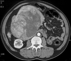 Neurogenic Tumor Simulates A Pancreatic Mass - CTisus CT Scan