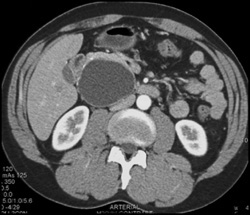 Pseudocyst - CTisus CT Scan