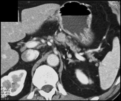 1 Cm Pancreatic Cancer With Dilated Pancreatic Duct - CTisus CT Scan