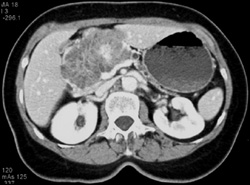 Serous Cystadenoma - CTisus CT Scan