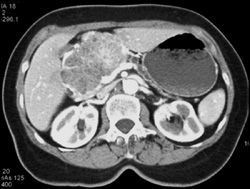 Serous Cystadenoma - CTisus CT Scan