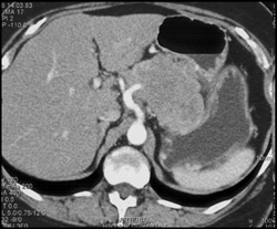 Mucinous Cystadenoma Invades the Splenic Vein and Artery - CTisus CT Scan