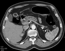 Pancreatic Cancer With Dilated Pancreatic Duct - CTisus CT Scan