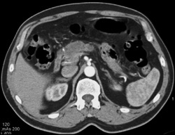 Pancreatic Cancer With Dilated Pancreatic Duct - CTisus CT Scan